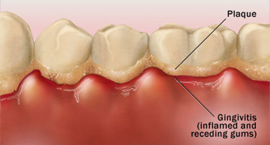 Top 4 nguyên nhân sâu răng bạn cần biết để tránh