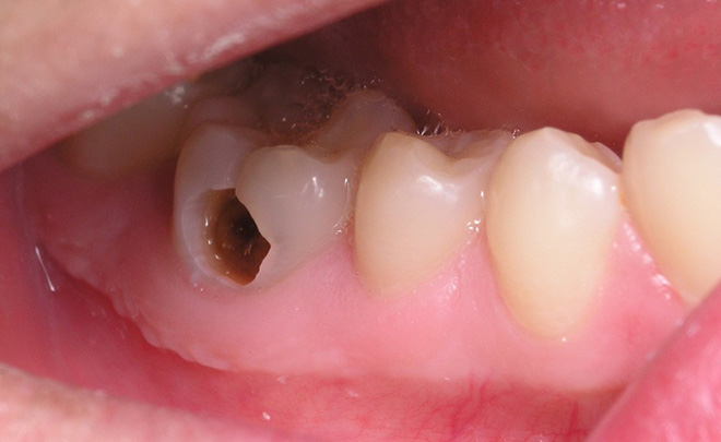 Top 4 nguyên nhân sâu răng bạn cần biết để tránh