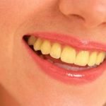 Ưu và nhược điểm của máng tẩy trắng răng
