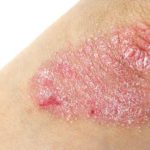 Những điều cần lưu ý với người bị eczema