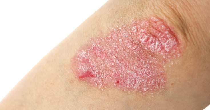 Những điều cần lưu ý với người bị eczema