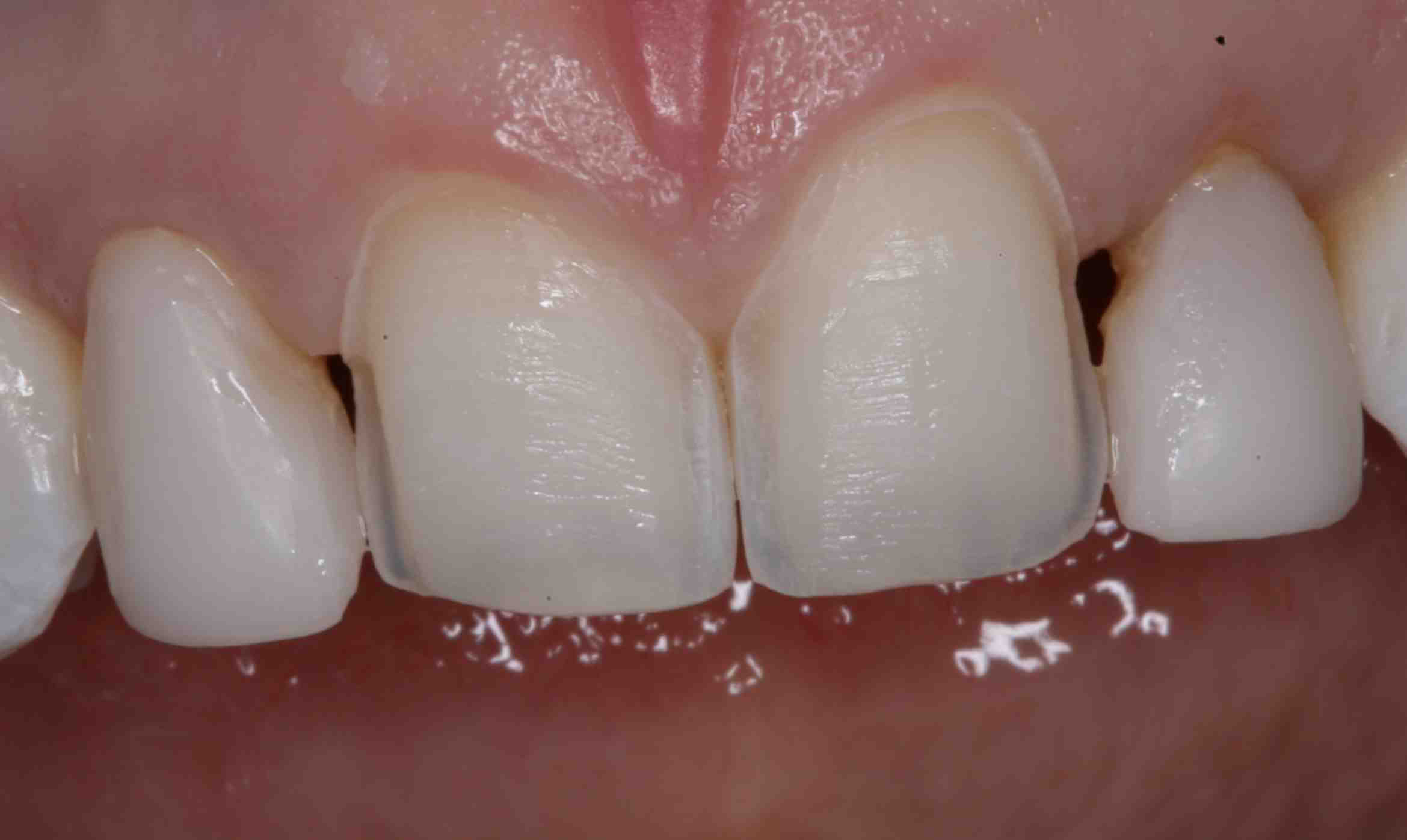 Sứ Veneer phục hồi thẩm mỹ bảo tồn răng thật