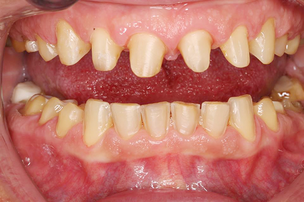 Quy trình thực hiện bọc răng sứ cho răng hàm 3