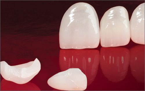 Quy trình thực hiện bọc răng sứ cho răng hàm 4