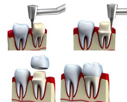 4 bước thực hiện bọc răng sứ cho răng hô hiệu quả