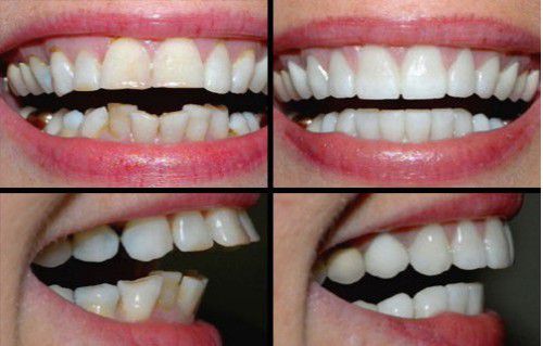 Bọc răng sứ cho răng khập khểnh như thế nào? 2