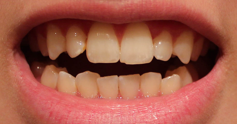  3 bí quyết để biết bọc răng sứ loại nào tốt nhất 1