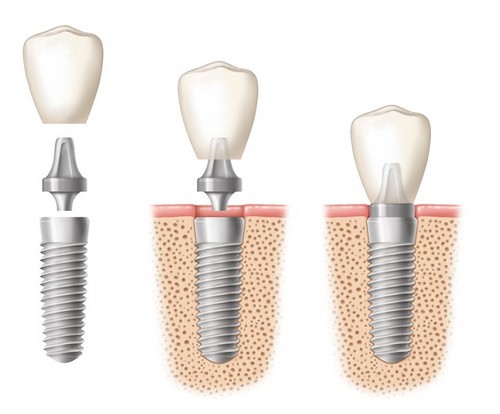 Cắm Implant răng cửa có ảnh hưởng răng xung quanh không? 1