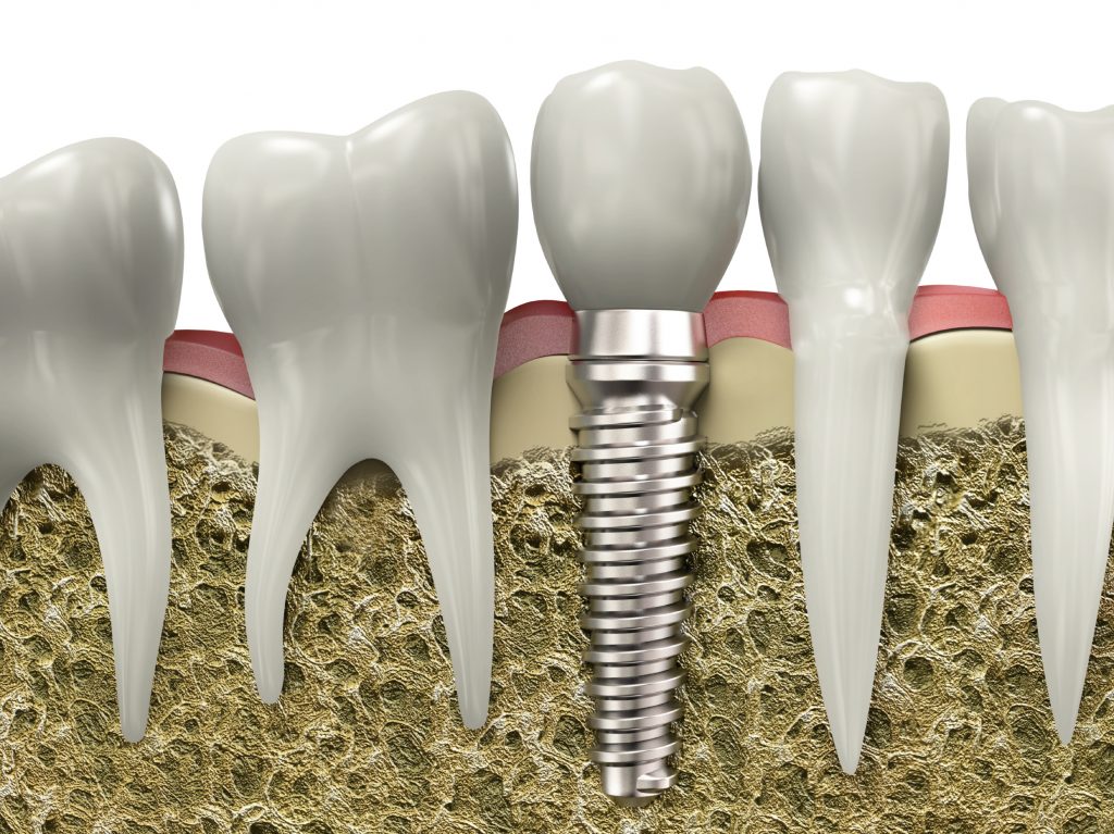 Chỉ điểm cấy ghép Implant ở đâu tốt cho mọi nhà? 1