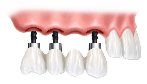 Có 2 cách dễ hiểu về cấy ghép răng implant như thế nào 1