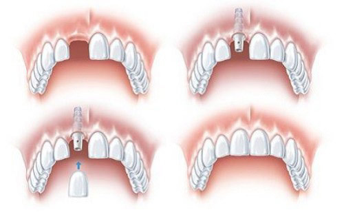 Có 2 cách dễ hiểu về cấy ghép răng implant như thế nào 2