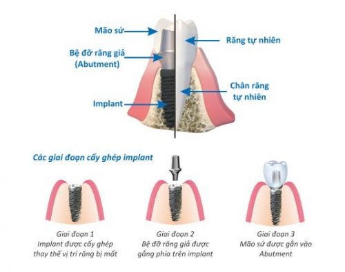 Nâng xoang hàm trong cấy ghép implant 2