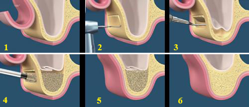 Nâng xoang hàm trong cấy ghép implant 3