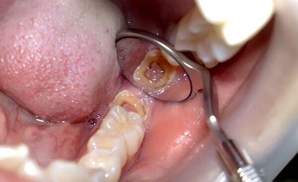 Răng bị hư tủy nên trồng răng giả ở đâu tốt nhất? 1