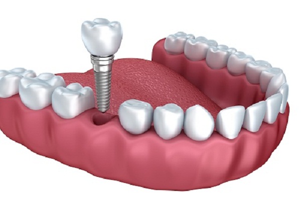 Thực hiện trồng răng hàm có đau không vậy? 2