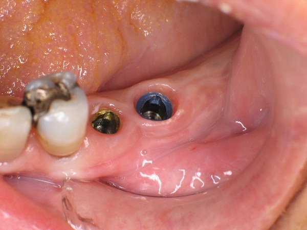 Bạn biết gì về phương pháp trồng răng Implant cố định 3