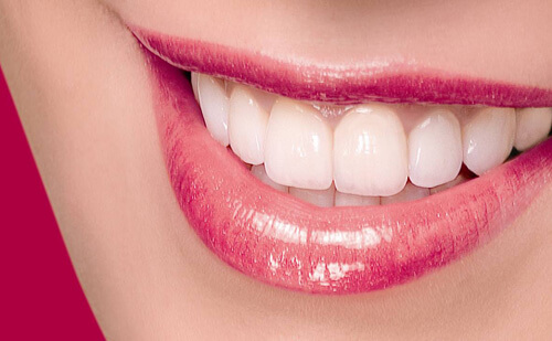 2 lý do chính sau giải đáp thắc mắc bọc răng sứ có tốt không 1