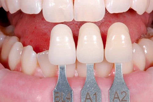 Bọc răng sứ có tác hại gì không? 2
