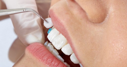 Bọc răng sứ được bao lâu có đảm bảo không? 2