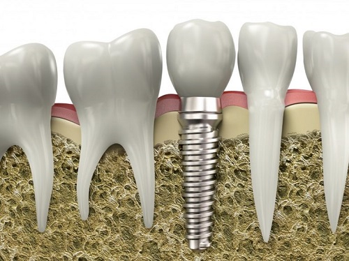 Implant nha khoa là gì? Tìm hiểu cấu tạo răng implant