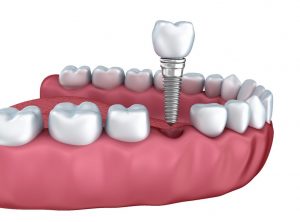 Implant nha khoa là gì? Tìm hiểu cấu tạo răng implant 2