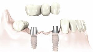 Implant nha khoa là gì? Tìm hiểu cấu tạo răng implant 3
