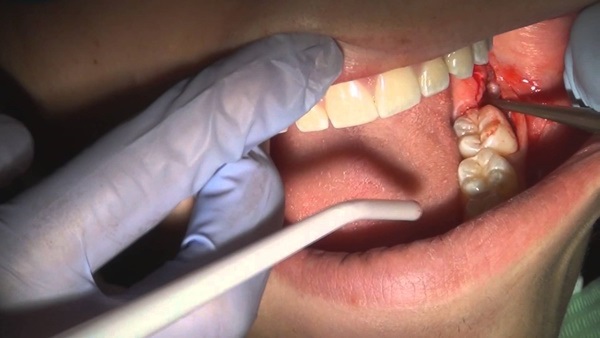 Nhổ răng khôn ở đâu tốt đảm bảo những yếu tố nào? 2