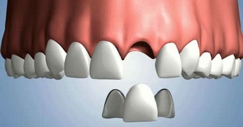 Răng bọc sứ bị lung lay phải làm sao? Cách khắc phục