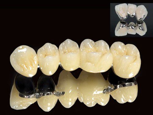 Răng sứ kim loại có tốt không? 1