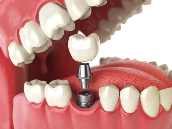 Kỹ thuật trồng răng implant ở đâu tốt? 2