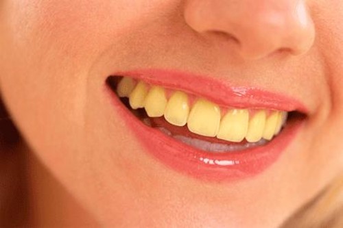 Răng vàng có tẩy trắng được không? 2