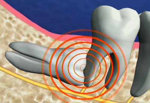 Nhổ răng khôn có đau không? Tham khảo ý kiến bác sĩ 1