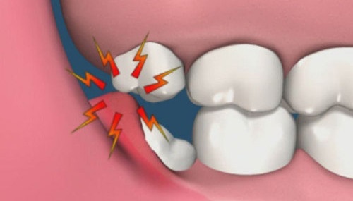 Nhổ răng khôn có nguy hiểm không? Lời khuyên bác sĩ 2