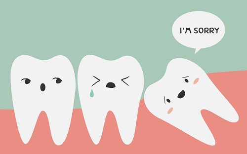 Nhổ răng khôn có nguy hiểm không? Lời khuyên bác sĩ 3