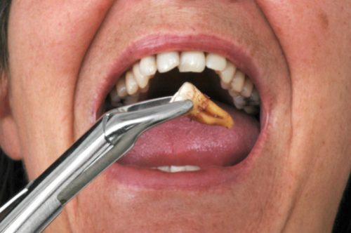Nhổ răng khôn giá bao nhiêu tiền là hợp lý nhất? 2