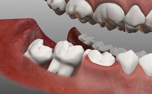 Răng khôn bị đau do đâu? Lý giải 1
