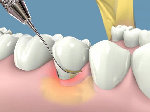 Răng khôn bị đau do đâu? Lý giải 2