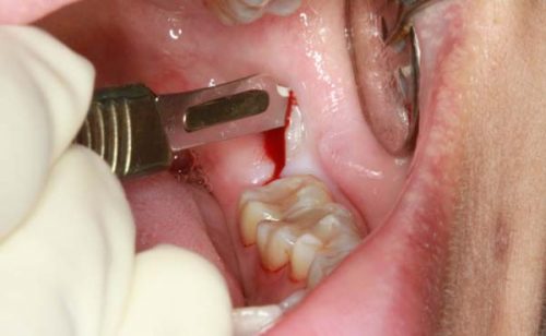 Răng khôn bị lợi trùm nên nhổ hay cắt lợi trùm? Vì sao? 3