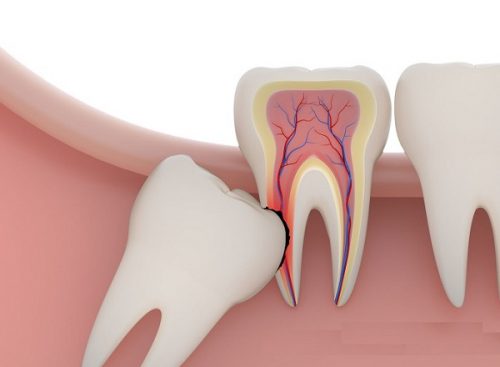 Răng khôn là gì và chúng thường có mấy chân? 1