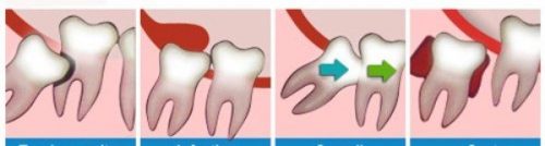 Răng khôn là gì và chúng thường có mấy chân? 2