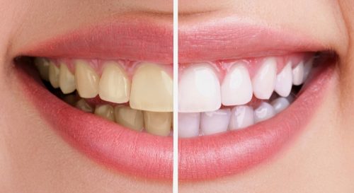 Tẩy trắng răng có hại không? 1