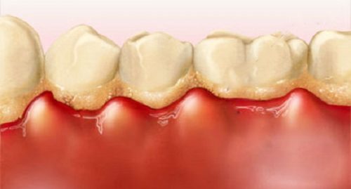 Cạo vôi răng có ảnh hưởng gì không? 1