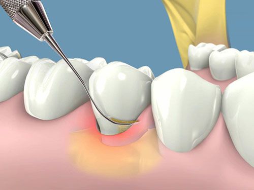 Cạo vôi răng có ảnh hưởng gì không? 3
