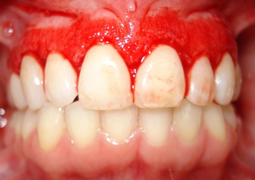 Chảy máu chân răng là bệnh gì? Nguyên nhân 1