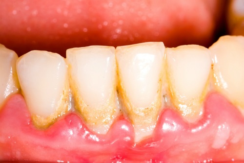 Nguyên nhân bị chảy máu nướu răng là do đâu? 2