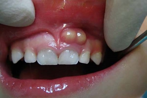 Các cách trị sưng nướu răng cho bạn 1