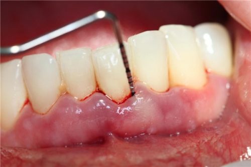 Các cách trị sưng nướu răng cho bạn 6