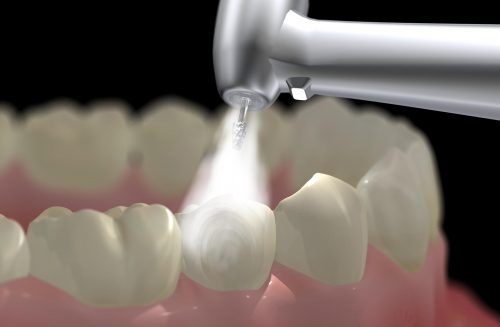 Cạo vôi răng mất bao lâu? 2