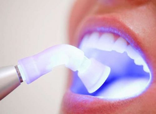 Tẩy trắng răng bằng laser bao nhiêu tiền? 2