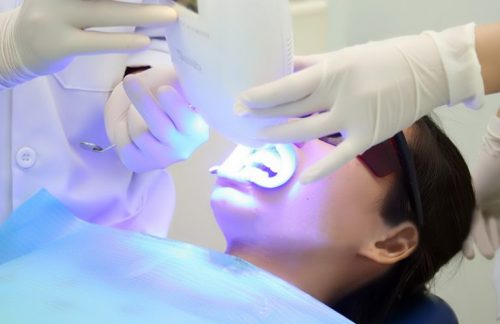 Tẩy trắng răng bằng laser whitening có hại không? 3